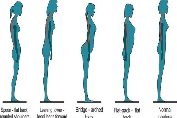 Cara Efektif Memperbaiki Postur Tubuh Sehari-hari