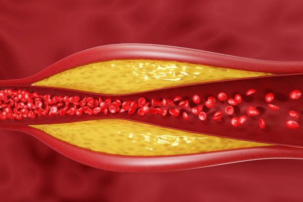 Fakta Medis Tentang Kolesterol: Apa yang Perlu Kamu Tahu?